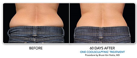 CoolSculpting Before and After Results