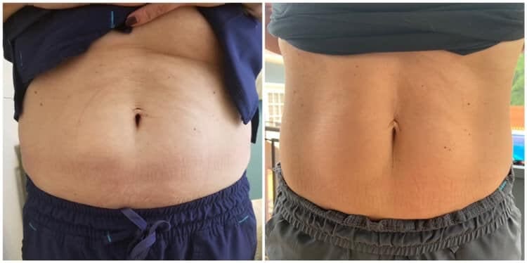 EMSCULPT Results