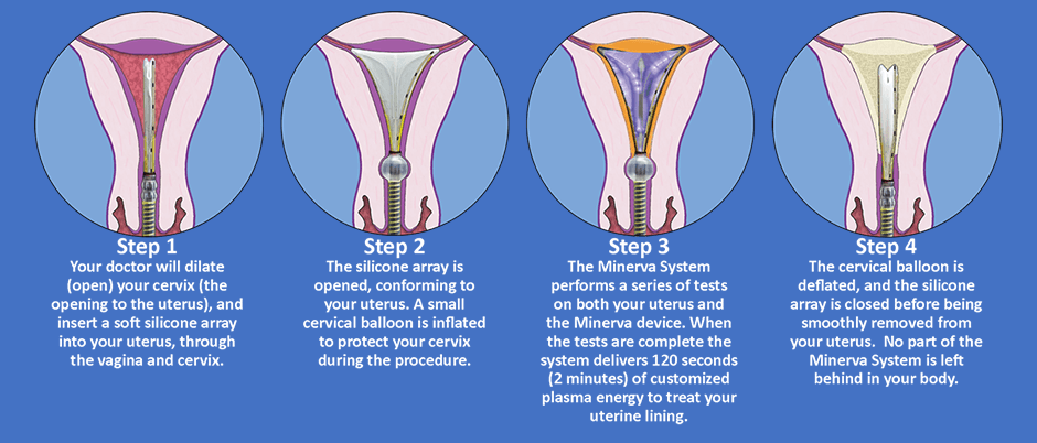 Steps of Endometrial Ablation Treatment